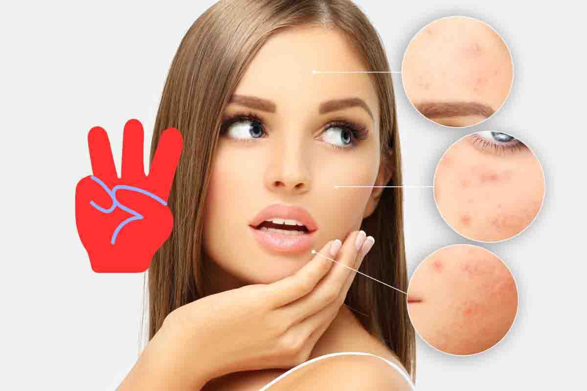 Come combattere i tre tipi di acne