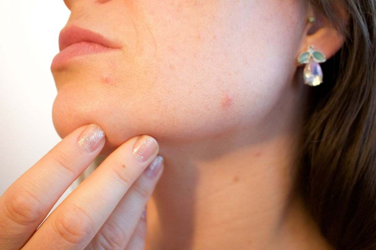 acne tre tipi come combatterla